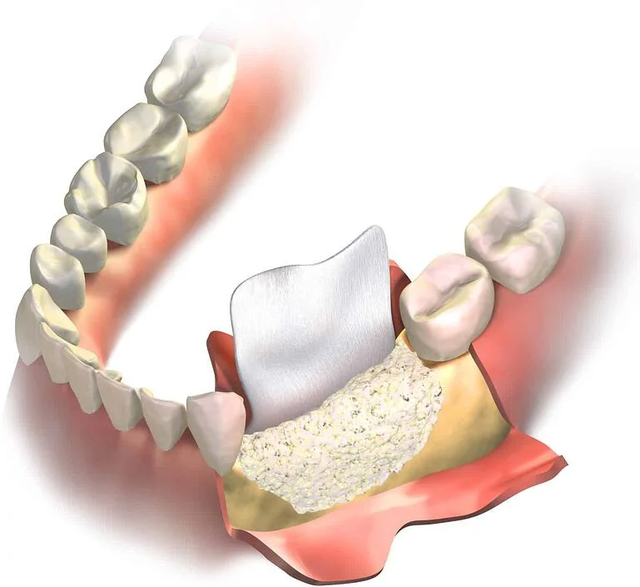 种植牙补骨粉有没有痛苦和风险？