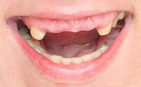 牙槽骨吸收严重，医生说要先植骨粉才能种牙，成功率高吗？