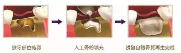 牙槽骨吸收严重，医生说要先植骨粉才能种牙，成功率高吗？