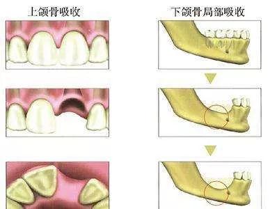 种植牙手术中为什么要植骨？