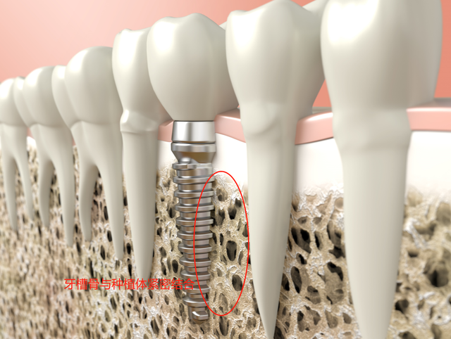 种植牙手术中为什么要植骨？