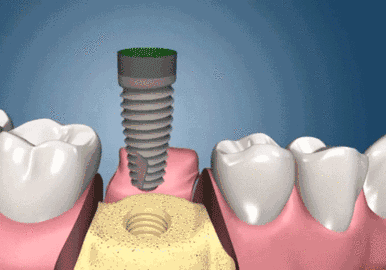 牙齿种植分三期，每次去医院要隔多久？