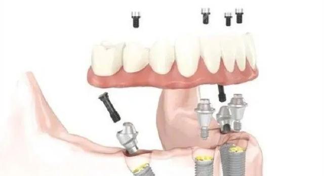 全口牙齿缺失后 应如何去选择合适的种植牙方案？