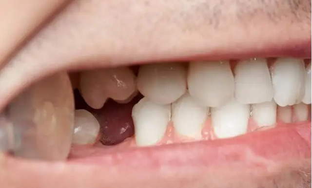 牙齿缺失的真正危害，远远不止一个“难看”！