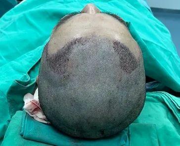 皮肤性病及医疗美容科成功实施毛发移植手术