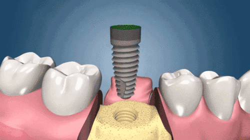 种植牙科普：揭秘种植牙修复全过程，每个步骤都很重要