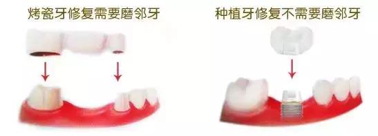 烤瓷牙VS 种植牙？哪种更好？