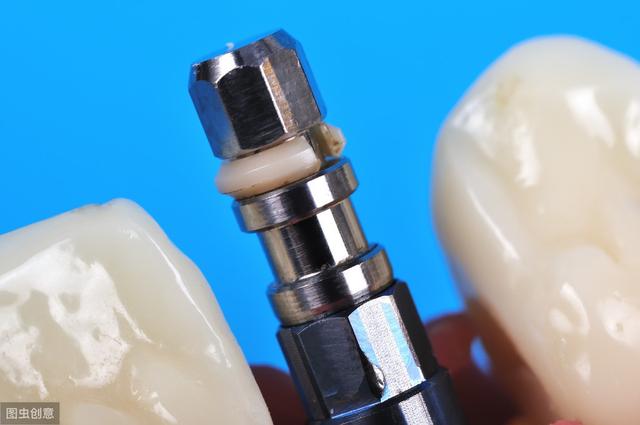 种植牙手术全过程，不是一次手术就可以解决的，过程比你想的复杂