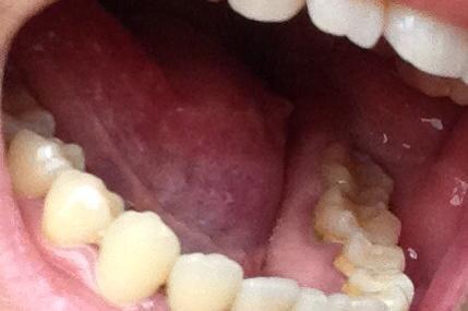 牙龈癌可不是牙龈瘤，严重会致命！致病原因可能还跟假牙有点关系