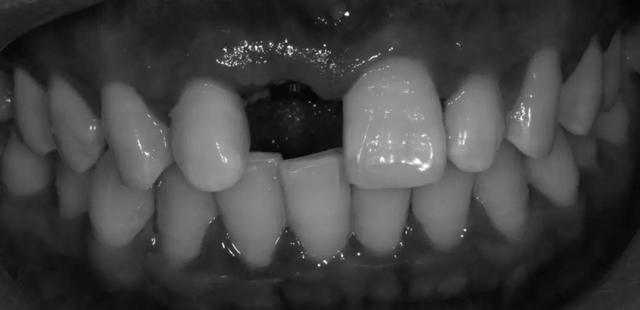 晋江市口腔医院牙科医师解答：为什么有些种植牙需要植骨？