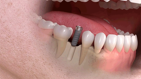 南阳市口腔医院：什么是种植牙、种牙过程、时机及后期维护