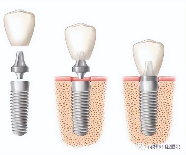 南阳市口腔医院：什么是种植牙、种牙过程、时机及后期维护