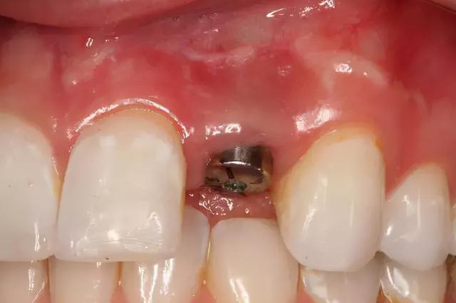 牙周病患者做种植牙失败率很高，种牙前要注意这方面