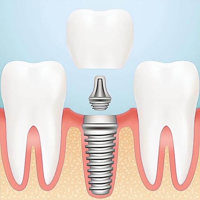 种植牙护理知识分享，科普18个危害与禁忌！