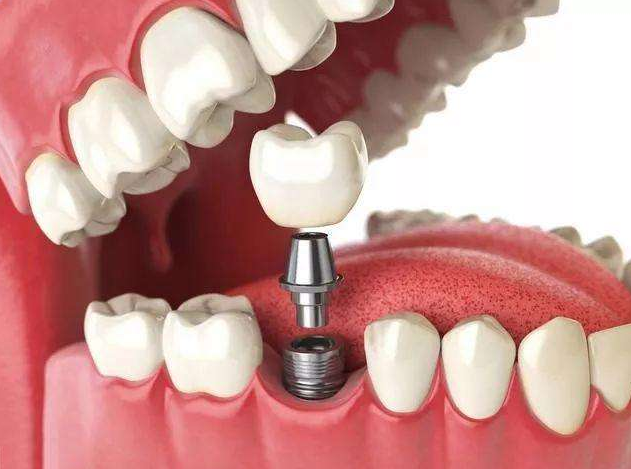 牙医详解：牙齿种植全流程，人生的第三副牙齿是如何种进口腔的呢