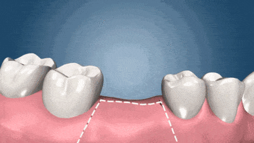 大连齿医生口腔科普 3分钟了解种植牙全过程！看后不再害怕了哦