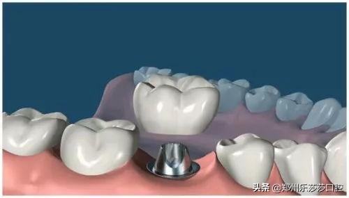 种植牙的治疗过程，你知道有哪些吗？