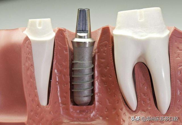 种植牙的治疗过程，你知道有哪些吗？