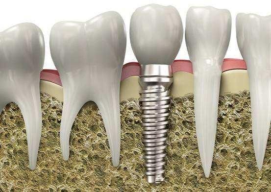 种植牙手术的中的黑科技，即刻种植即刻使用，牙科医生帮你分析