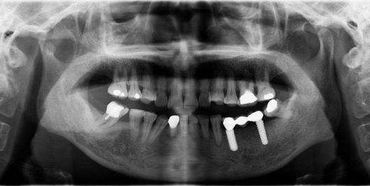 种植牙手术的中的黑科技，即刻种植即刻使用，牙科医生帮你分析