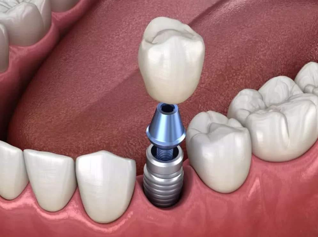 牙医详解：牙齿种植全流程，人生的第三副牙齿是如何种进口腔的呢