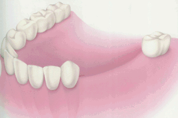 大连齿医生口腔科普 3分钟了解种植牙全过程！看后不再害怕了哦