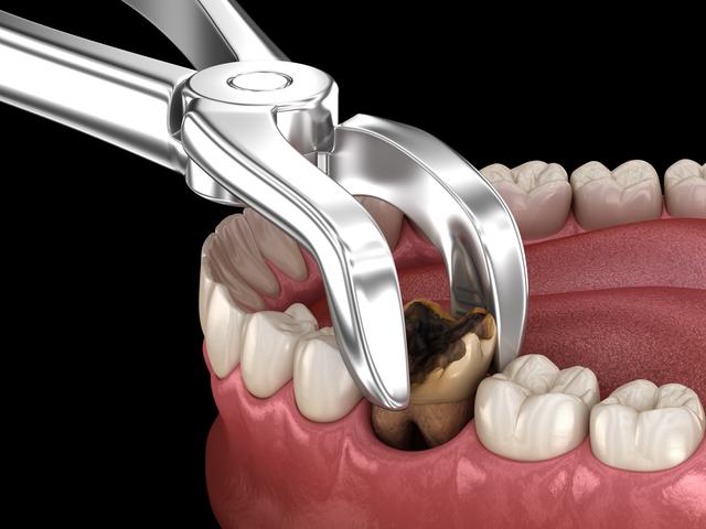 “即拔即种”种植牙手术后，我们应该注意什么？