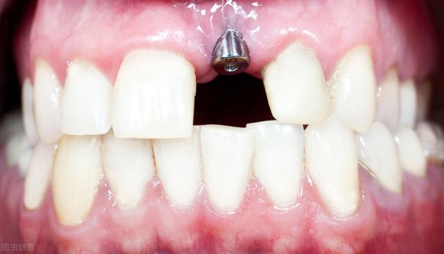 种植牙的原理是什么？到底应用了什么技术？为什么这么贵？