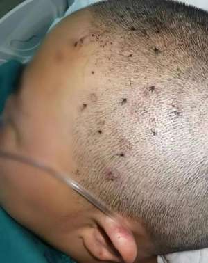 美女踩马蜂(触目惊心11岁女童被伤了近80处，紧急抢救)