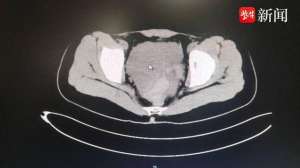 美女啪啪出血(女孩同房后大出血，这个病要了解，能救命)